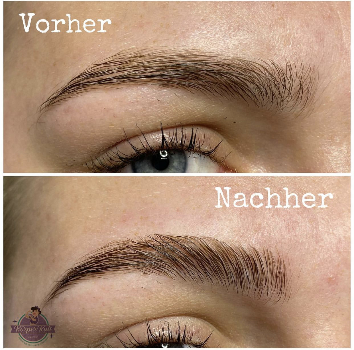Browlifting